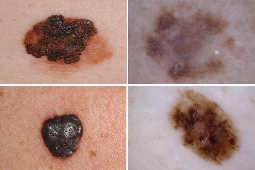 Melanoomaluomet voivat näyttää vaikka tältä. Kuvat: www.euromelanoma.org